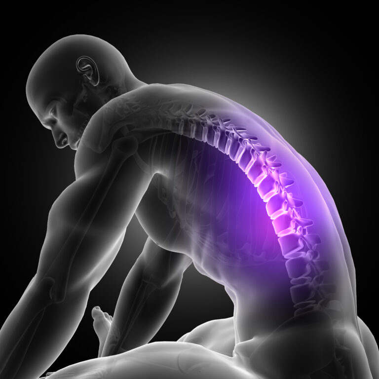 Title: Understanding Dorsal Kyphosis: Causes, Treatment, and Prevention Introduction