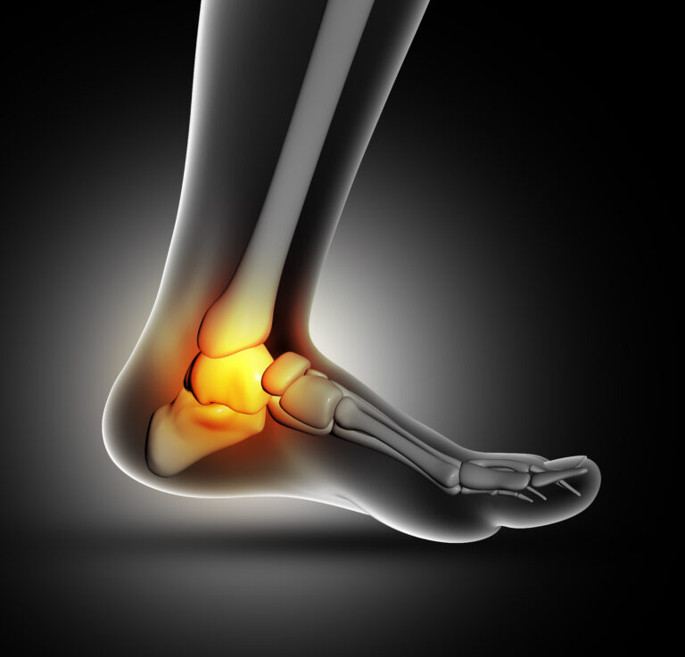Understanding Ankle Sprains: Causes, Treatment, and Prevention Introduction